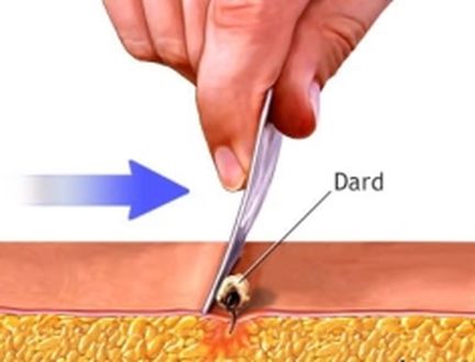 Faire glisser le tranchant de la lame paralllement  la surface de la peau